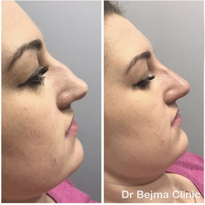 Non surgical nose job Dr Bejma Medical Clinic